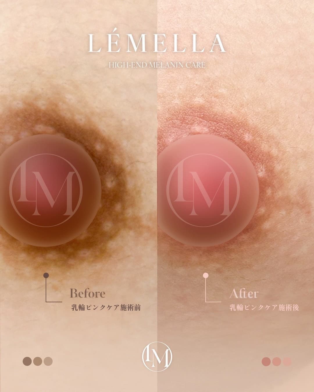 乳輪のビフォーアフター