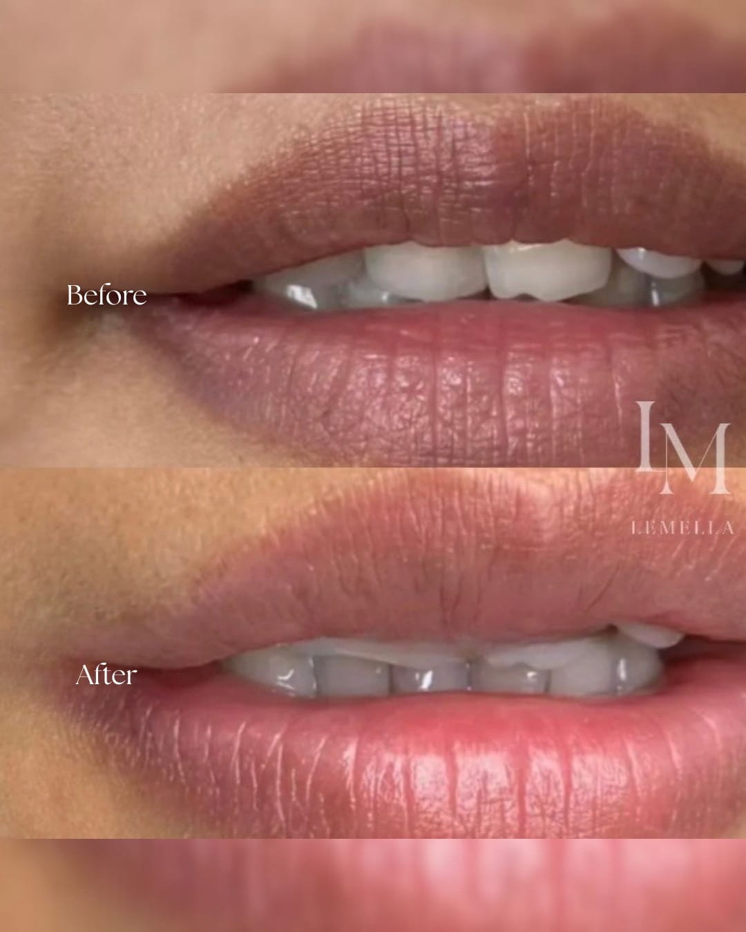 唇のビフォーアフター