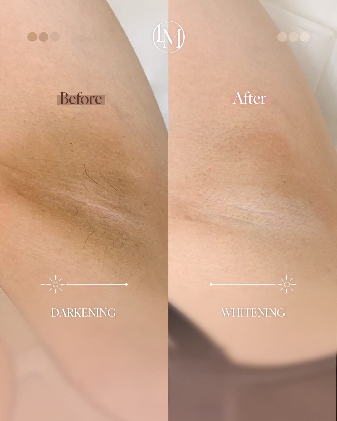 脇のビフォーアフター