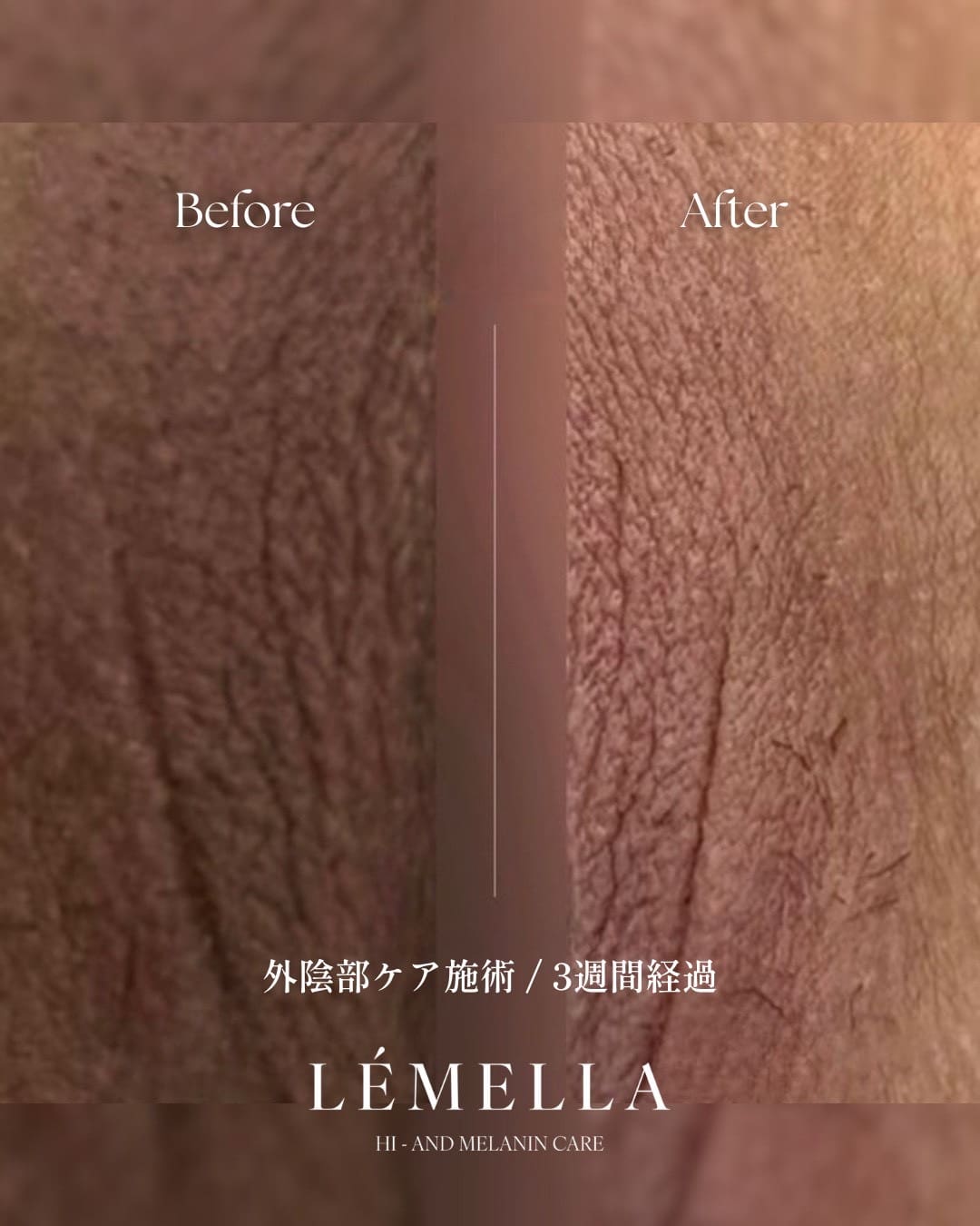 外陰部のビフォーアフター